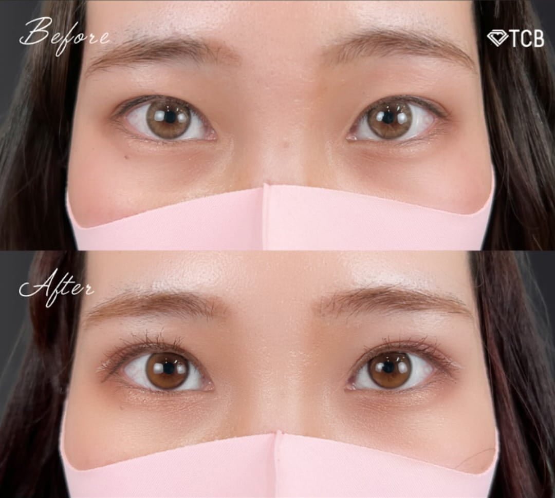 二重埋没の症例写真01