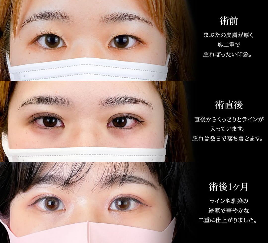 二重埋没の症例写真02