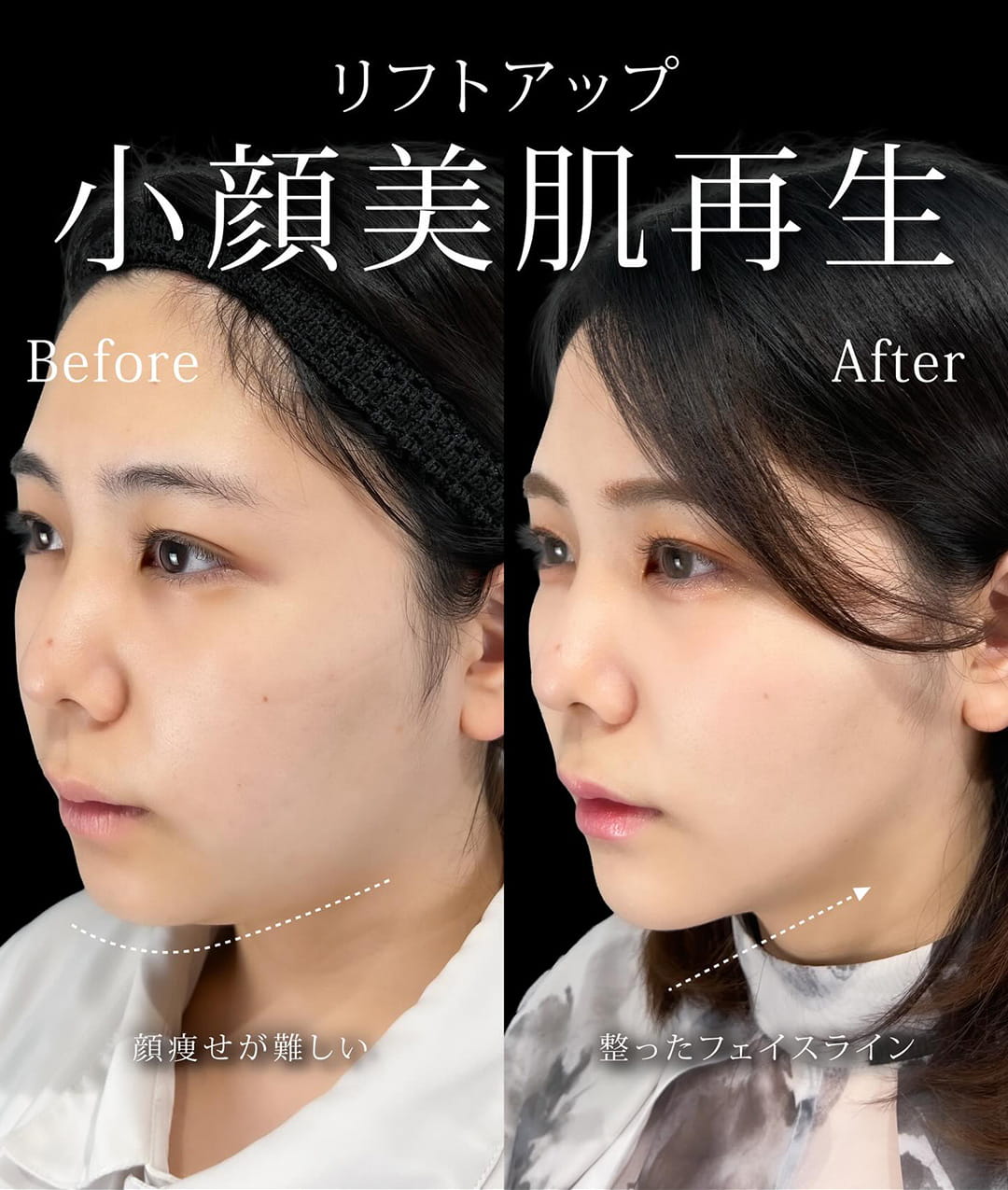 小顔美肌再生の症例写真01