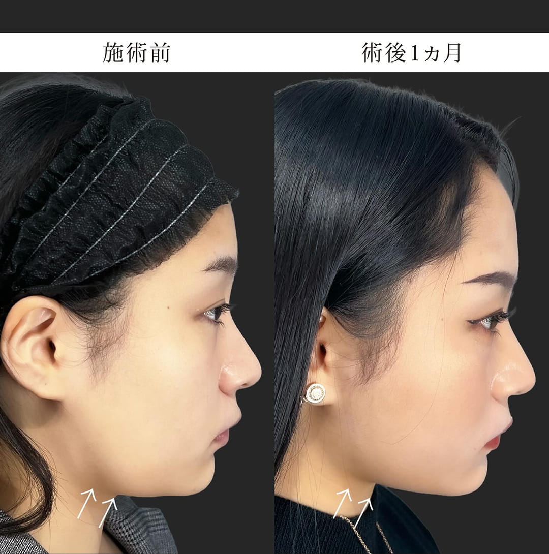 小顔美肌再生の症例写真02