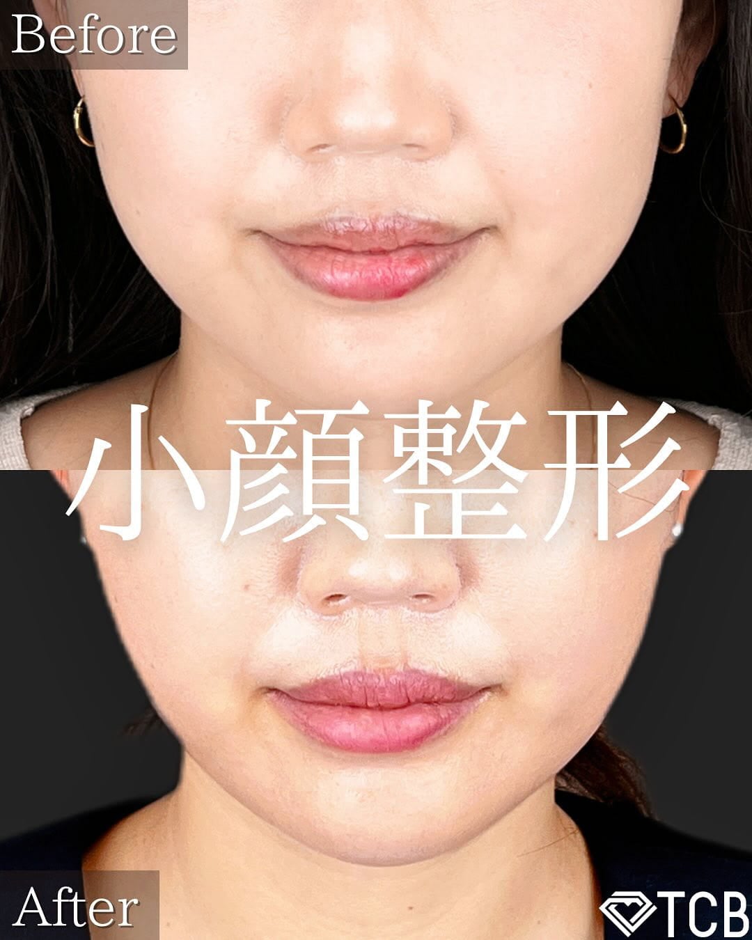 小顔美肌再生の症例写真03