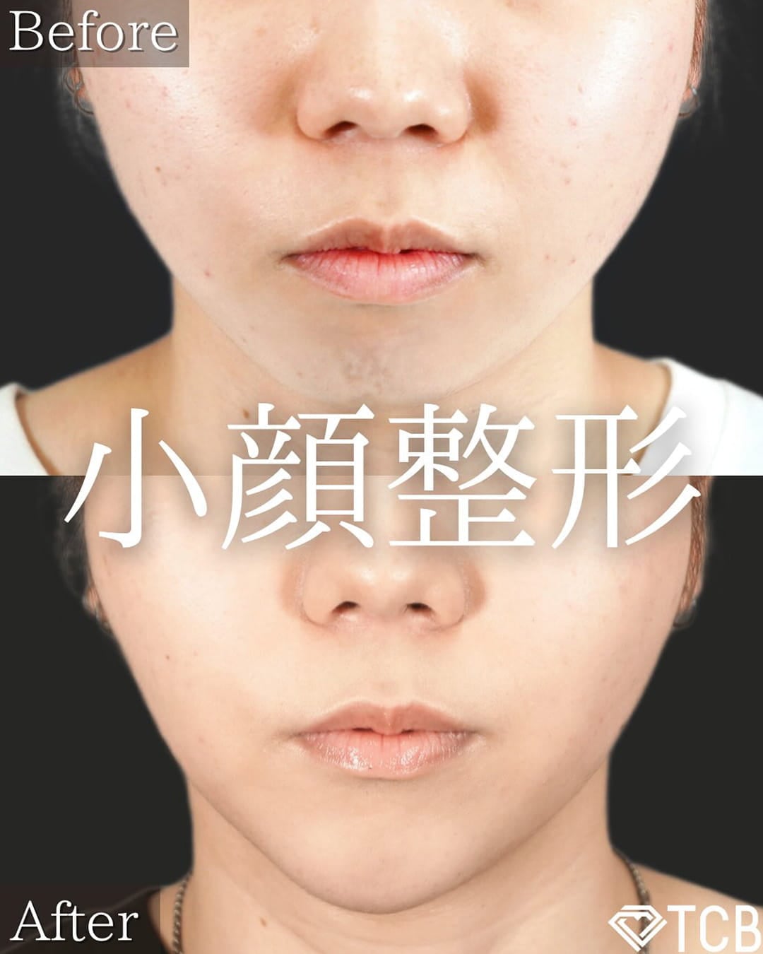 小顔美肌再生の症例写真04