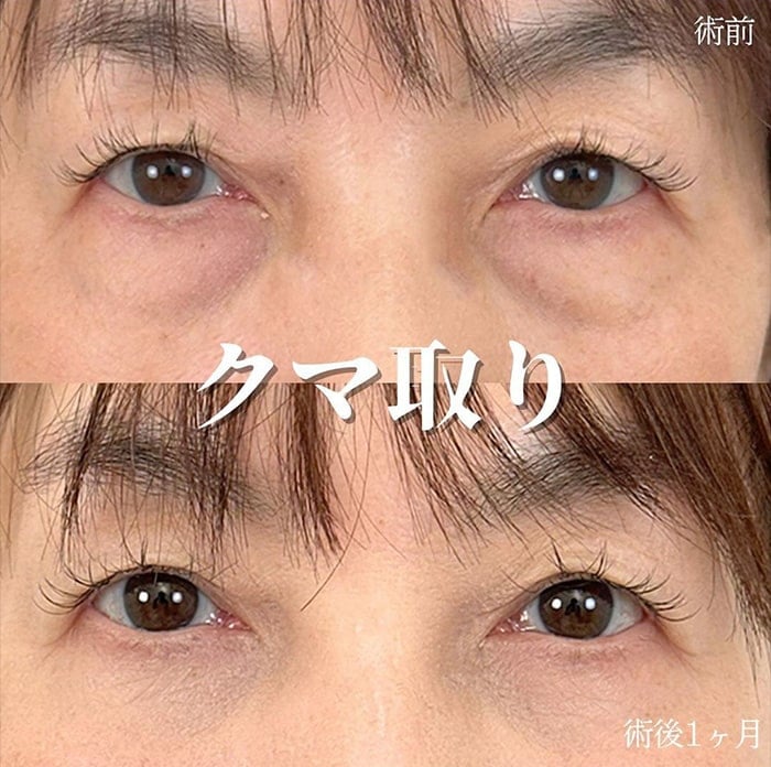 切らない目の下のクマ取り・目の下のたるみ（ふくらみ）取りの症例写真03