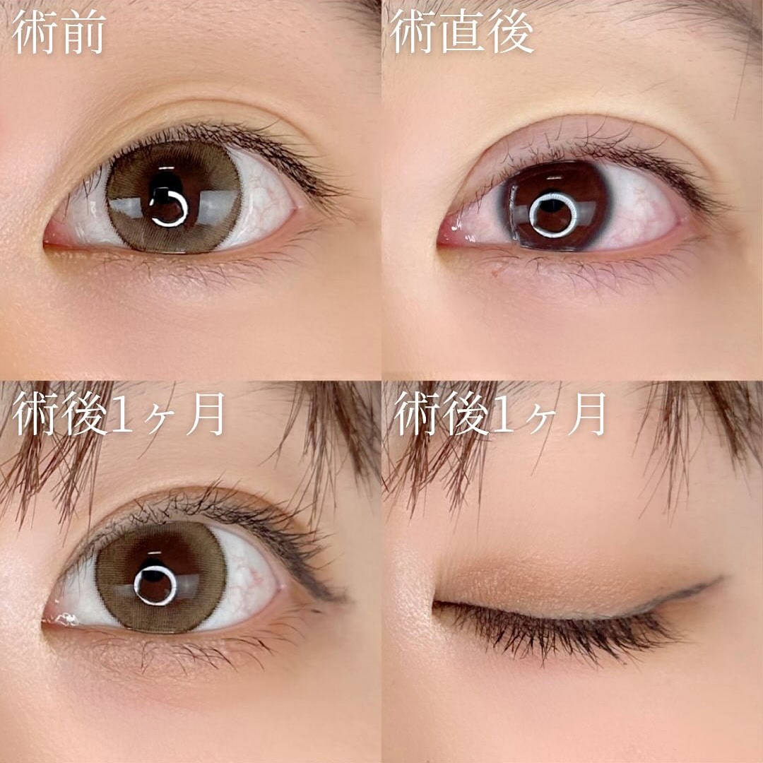 二重埋没の症例写真01