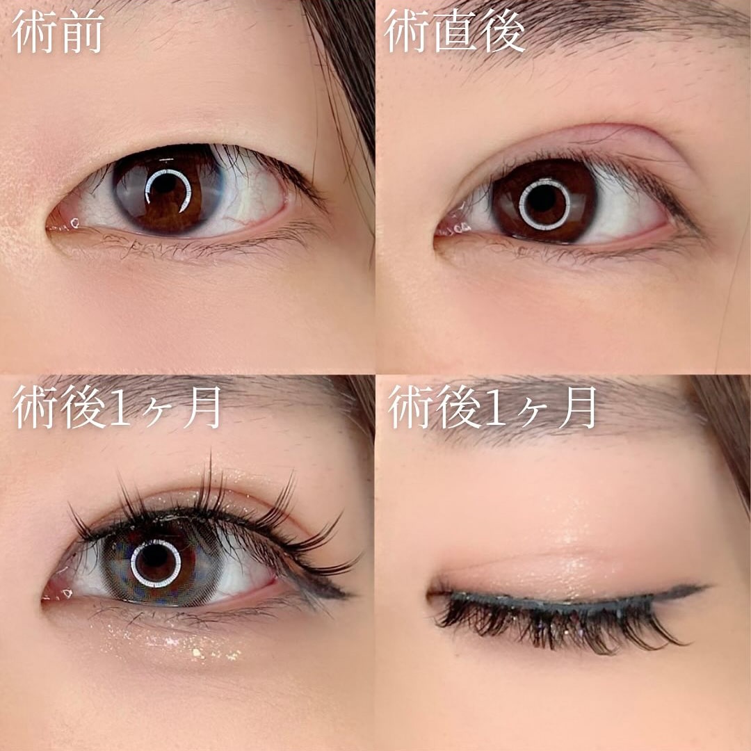 二重埋没の症例写真02