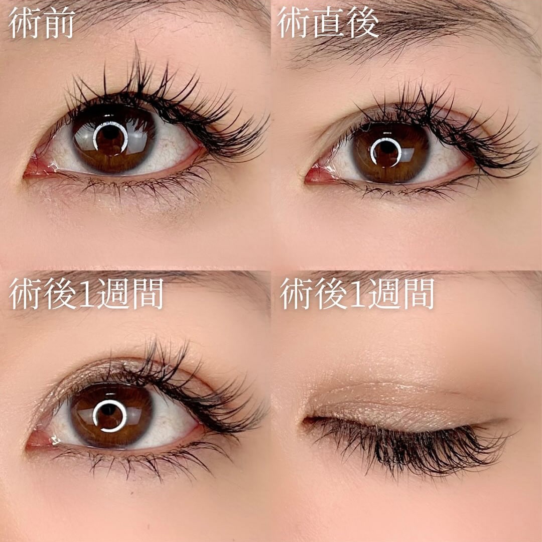 二重埋没の症例写真03