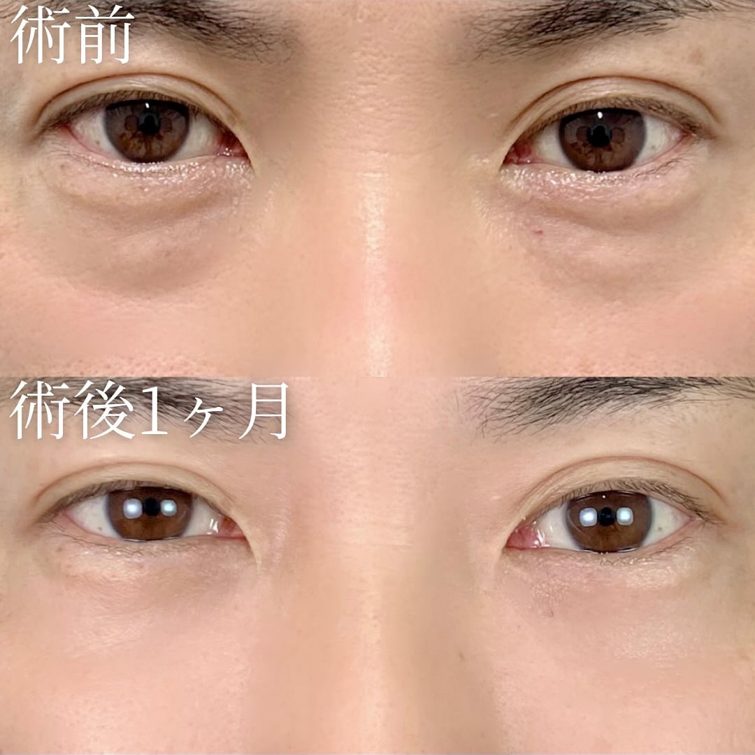 切らない目の下のクマ取り・目の下のたるみ（ふくらみ）取りの症例写真01