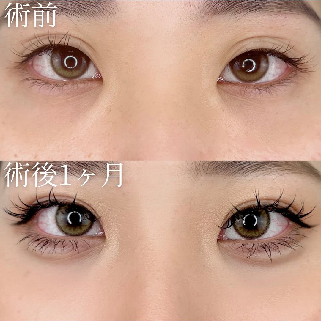 切らない目の下のクマ取り・目の下のたるみ（ふくらみ）取りの症例写真02