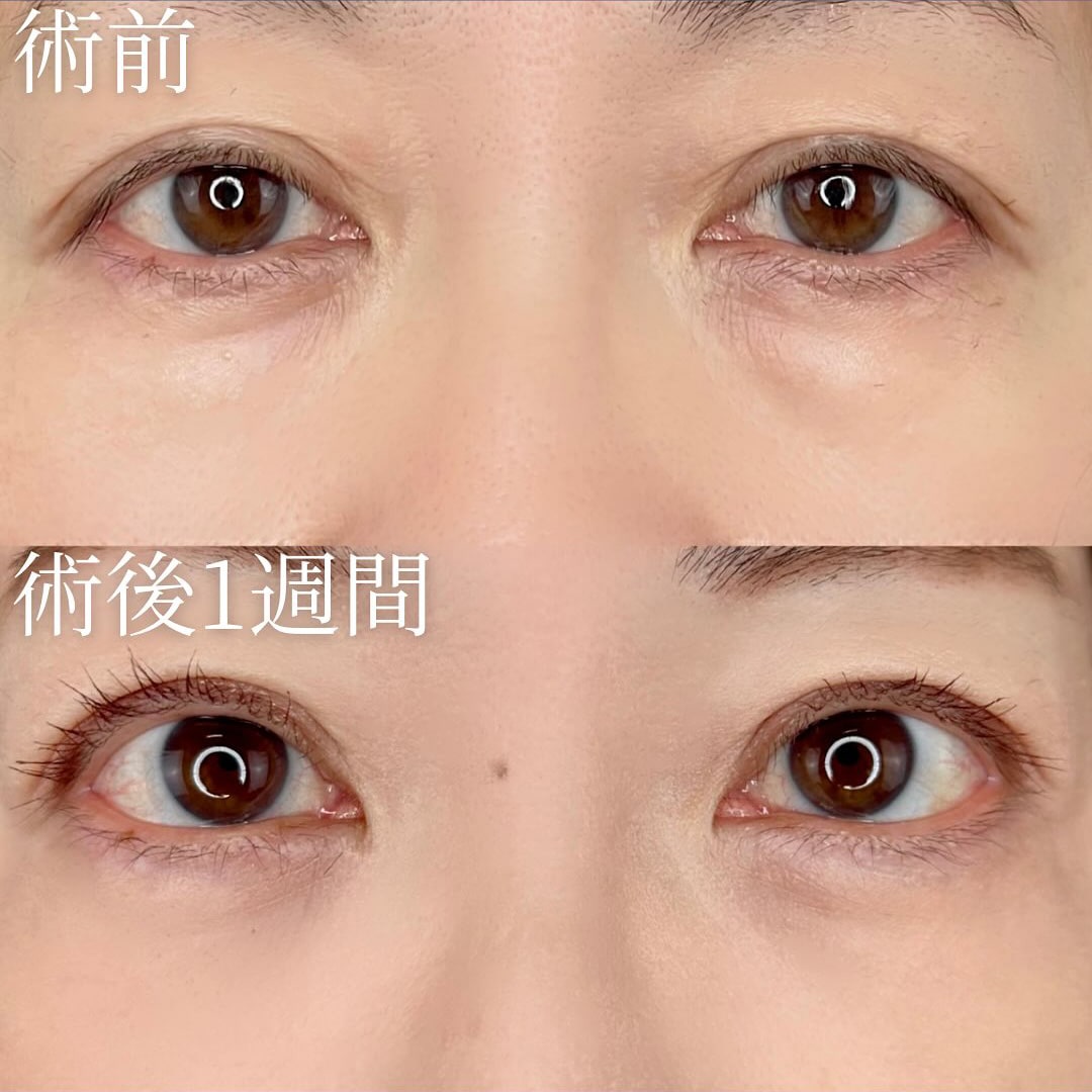 切らない目の下のクマ取り・目の下のたるみ（ふくらみ）取りの症例写真03