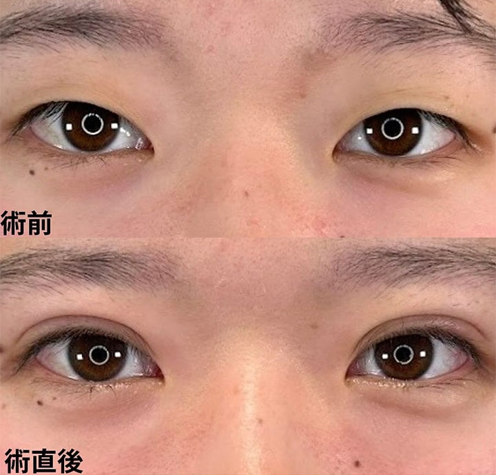 二重埋没の症例写真01