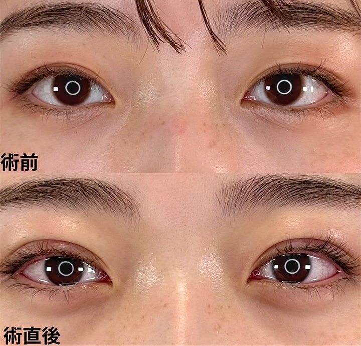 二重埋没の症例写真02