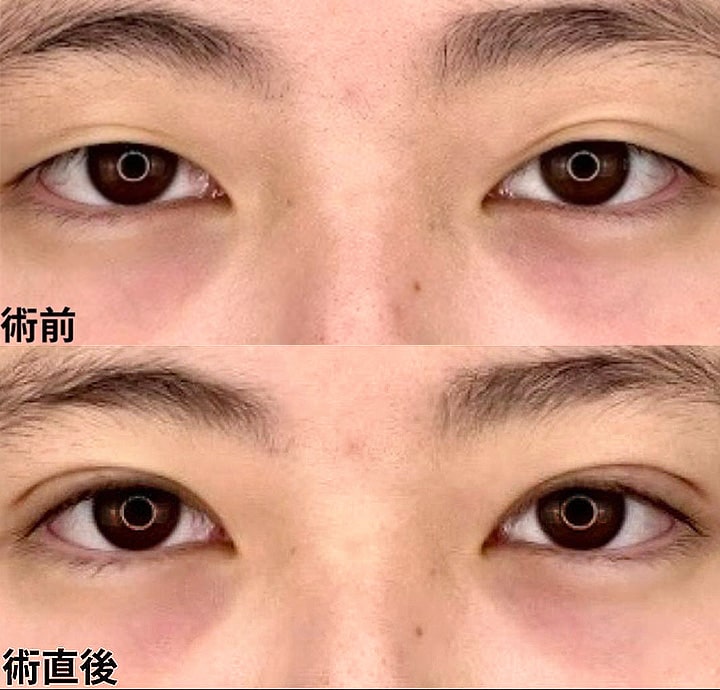 二重埋没の症例写真03