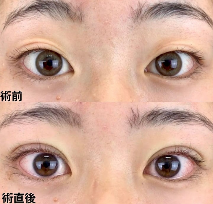 二重埋没の症例写真04
