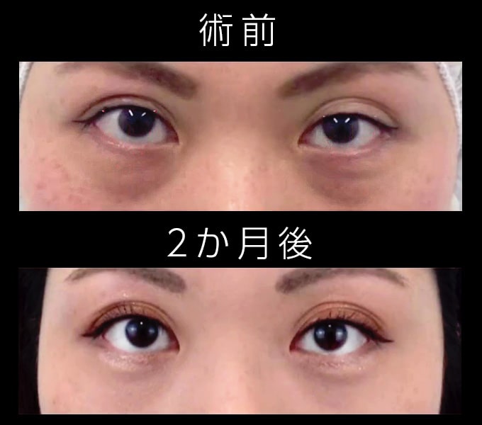 皮膚を切らない目の下のクマ取り・たるみ（ふくらみ）取りの症例写真01