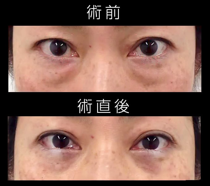 皮膚を切らない目の下のクマ取り・たるみ（ふくらみ）取りの症例写真02