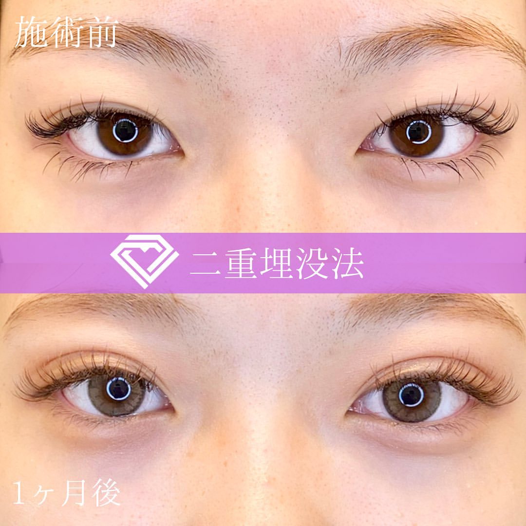 二重埋没の症例写真01