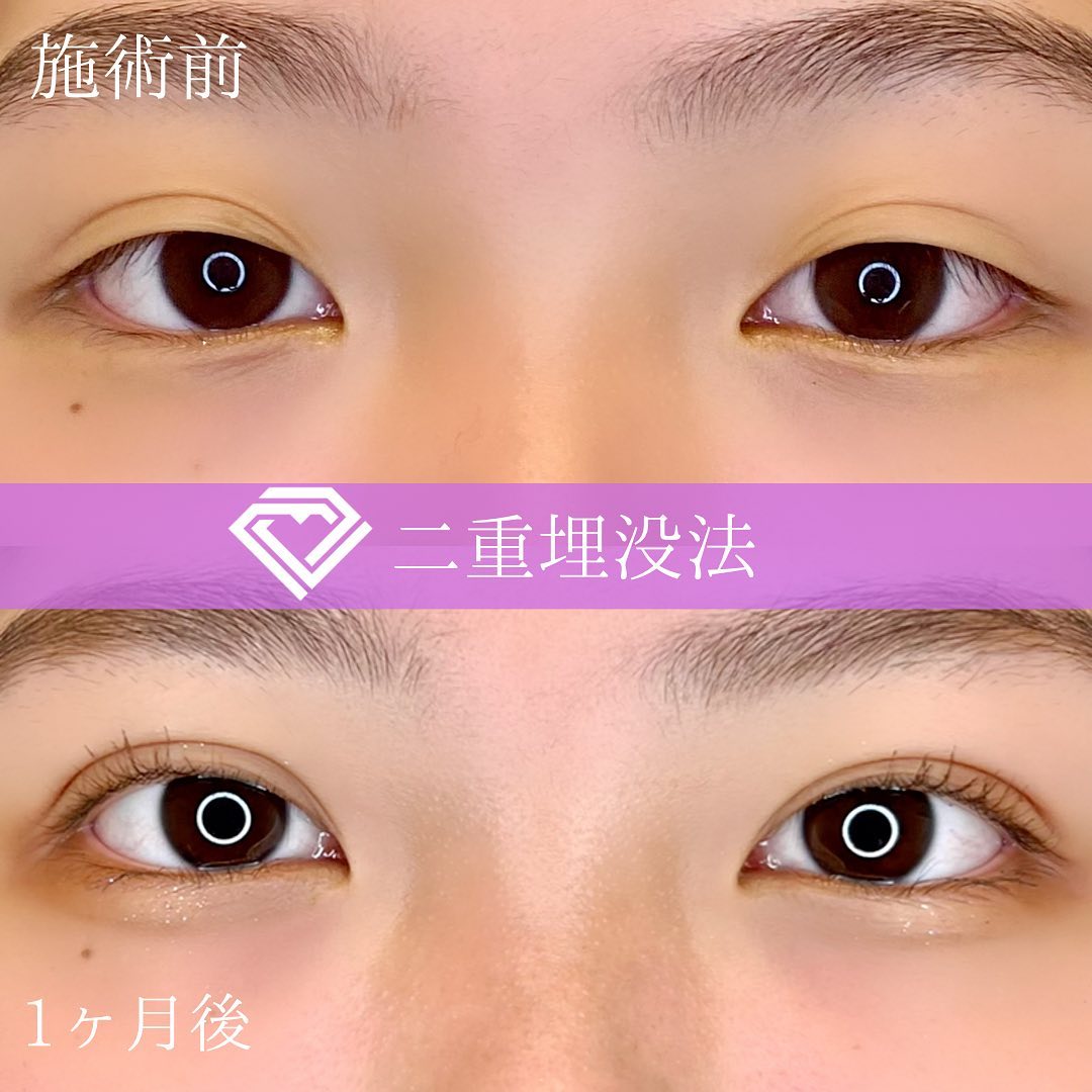 二重埋没の症例写真02