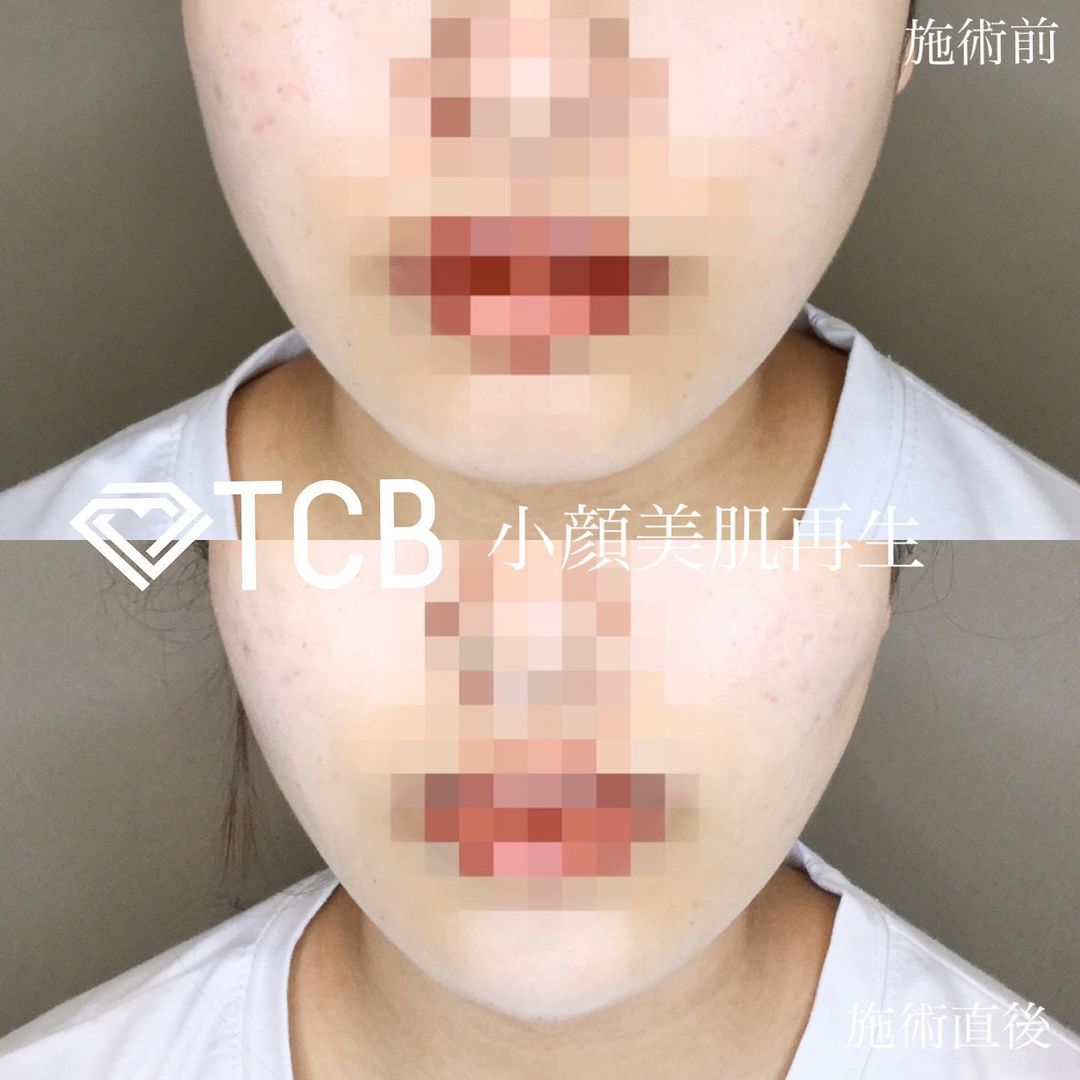 小顔美肌再生の症例写真01