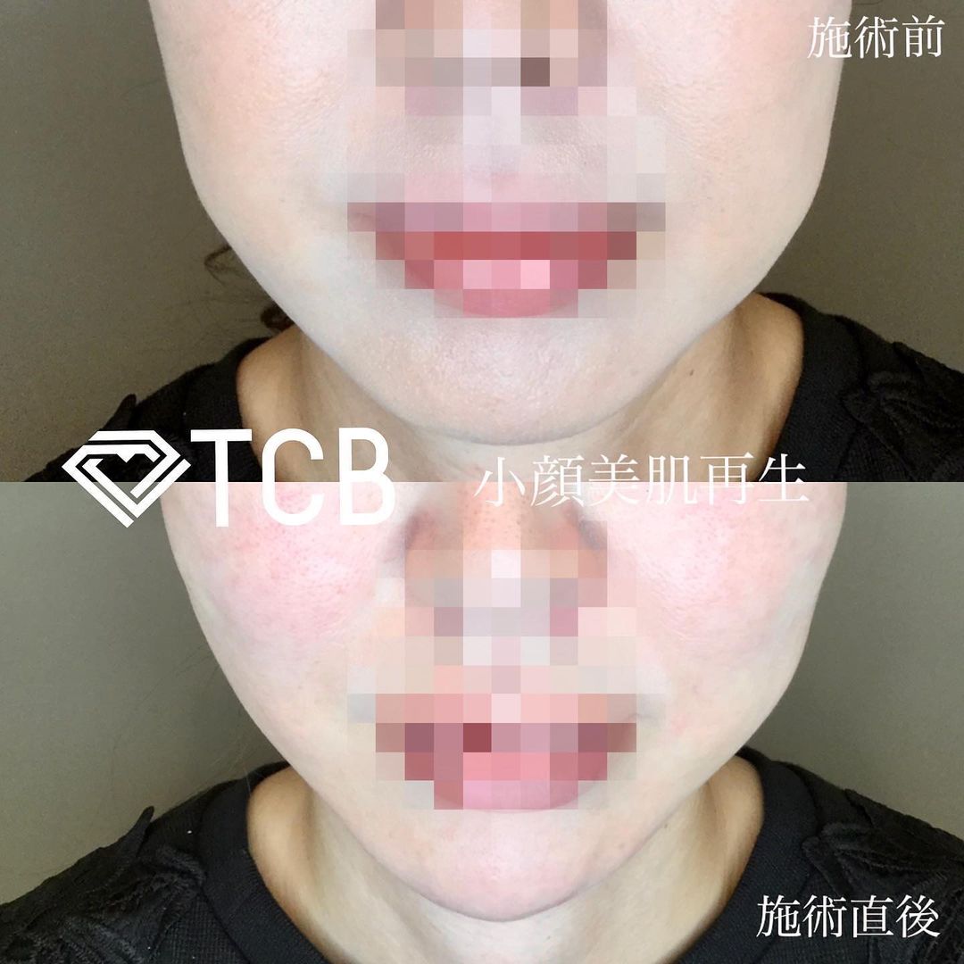 小顔美肌再生の症例写真02