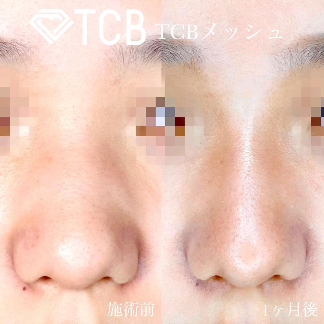 TCBメッシュの症例写真01