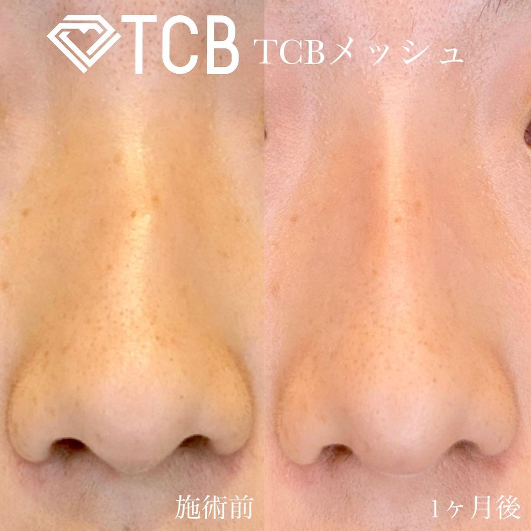 TCBメッシュの症例写真02