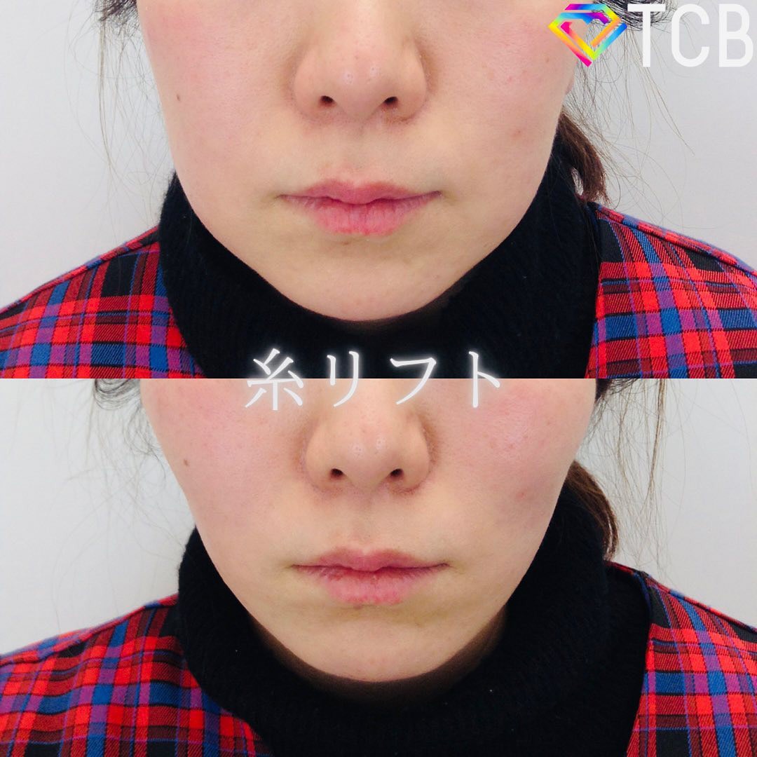TCB小顔リフトの症例写真02