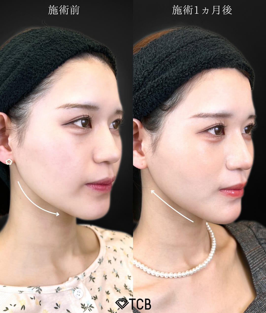 小顔美肌再生の症例写真01