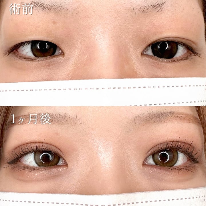 二重埋没の症例写真02