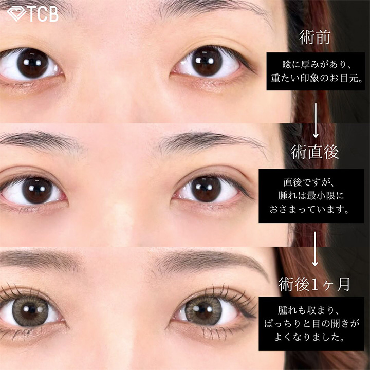 二重埋没の症例写真04