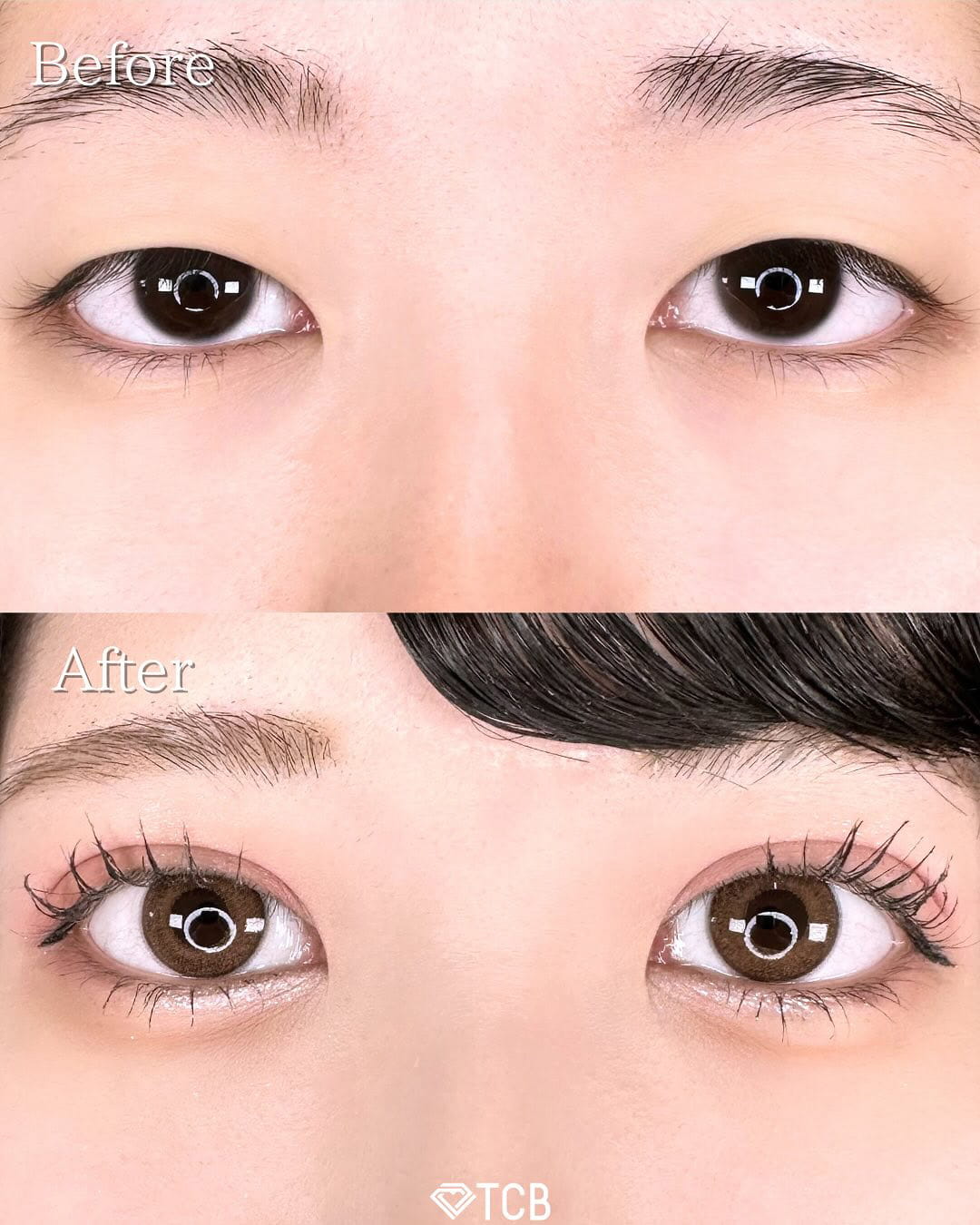 二重埋没の症例写真02