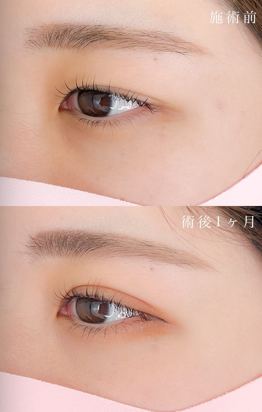 二重埋没の症例写真03