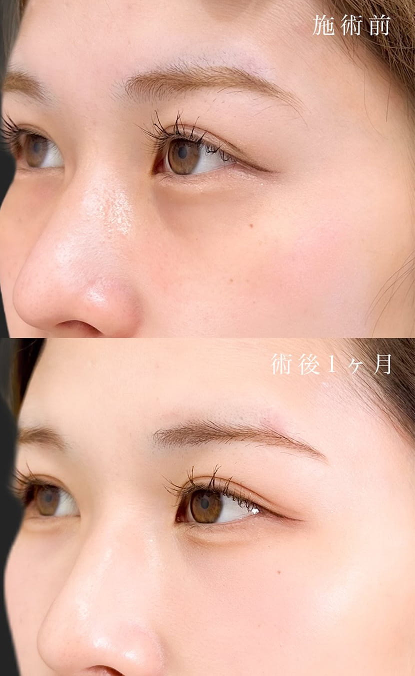 切らない目の下のクマ取り・目の下のたるみ（ふくらみ）取りの症例写真01