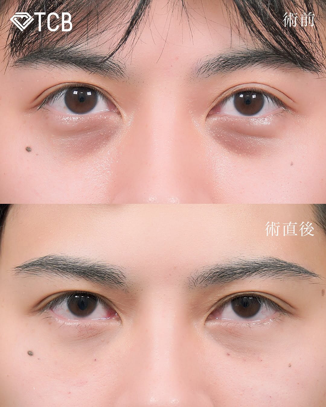 切らない目の下のクマ取り・目の下のたるみ（ふくらみ）取りの症例写真02