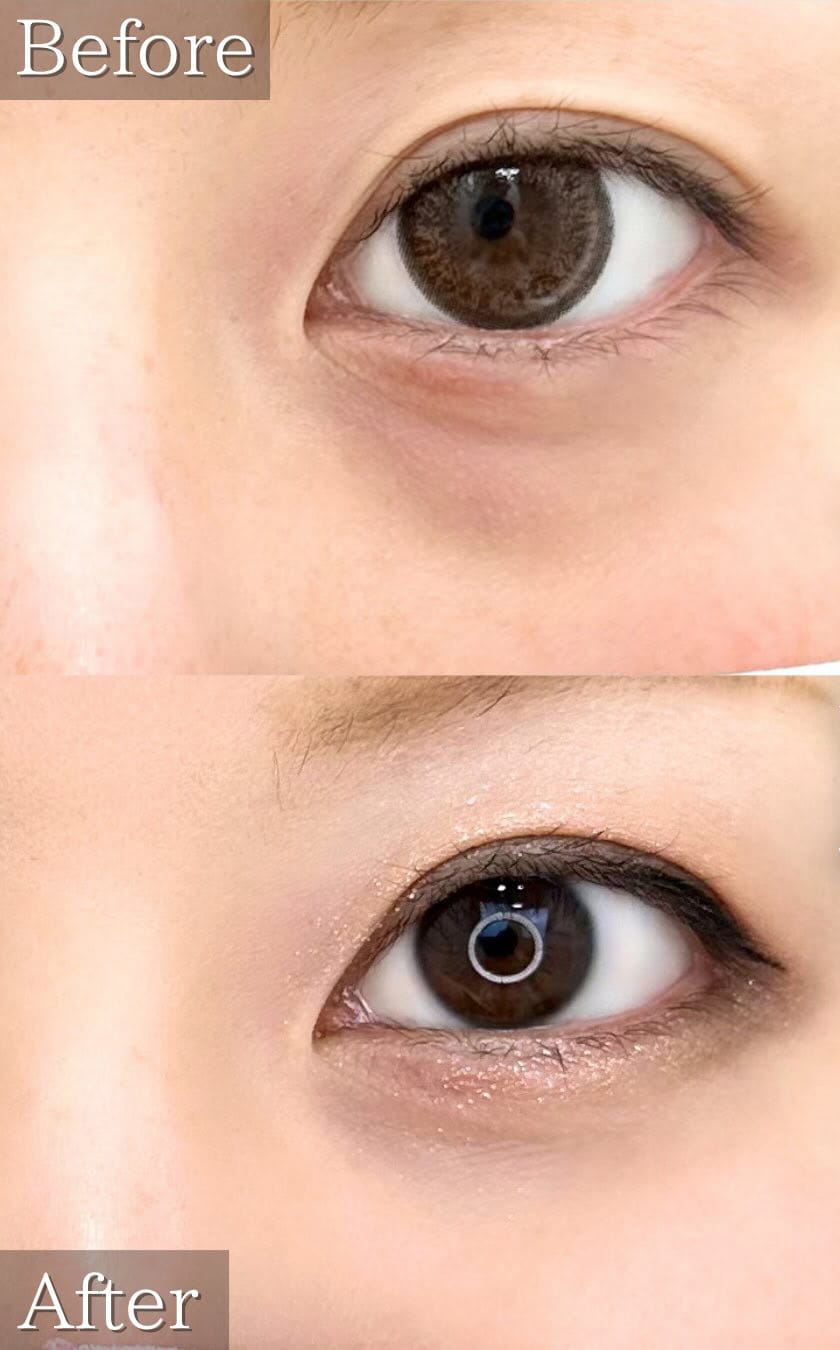 切らない目の下のクマ取り・目の下のたるみ（ふくらみ）取りの症例写真03