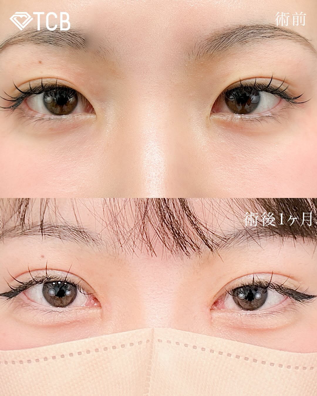 二重埋没の症例写真02