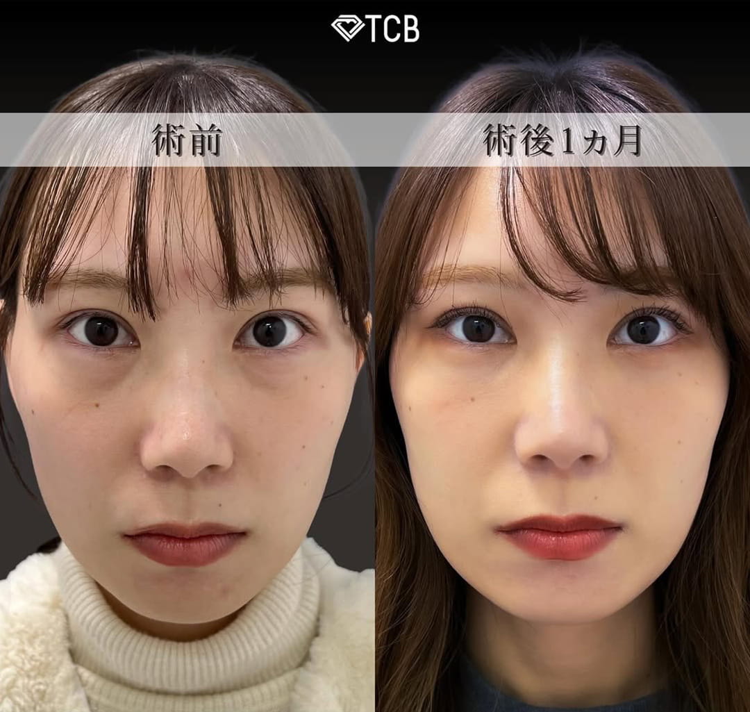 皮膚を切らない目の下のクマ取り・たるみ（ふくらみ）取りの症例写真02