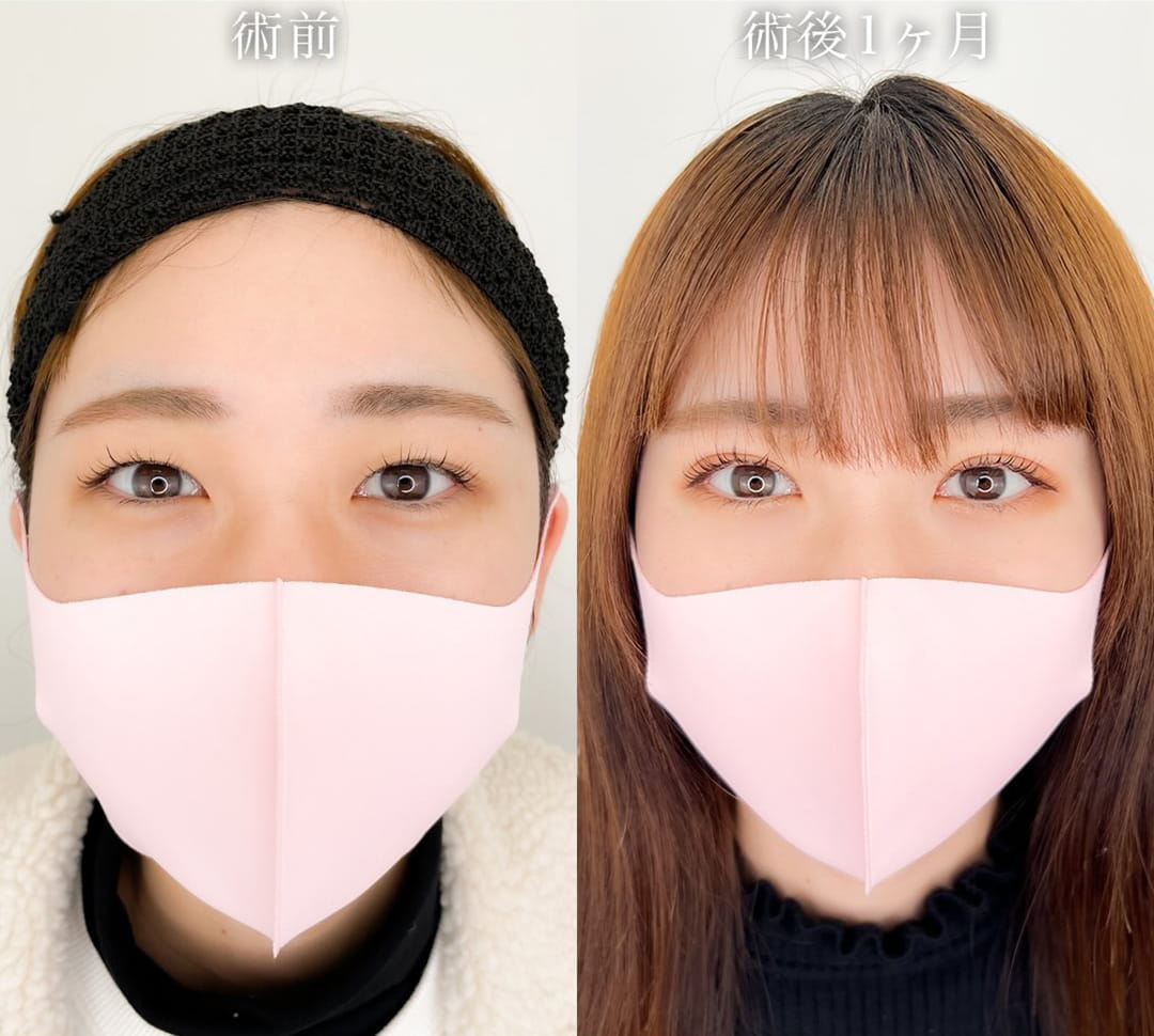 二重埋没の症例写真01