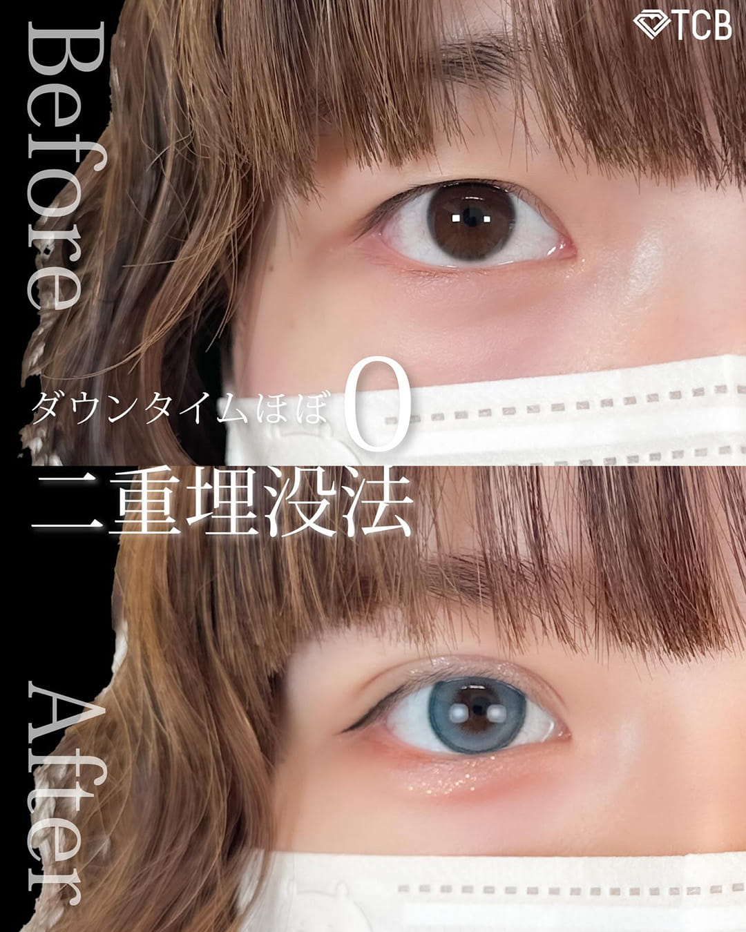 二重埋没の症例写真02