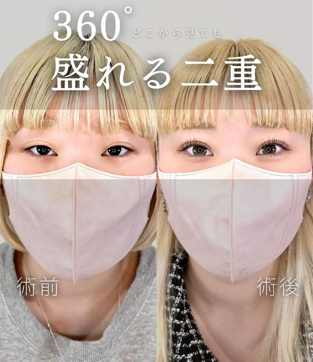 二重埋没の症例写真03