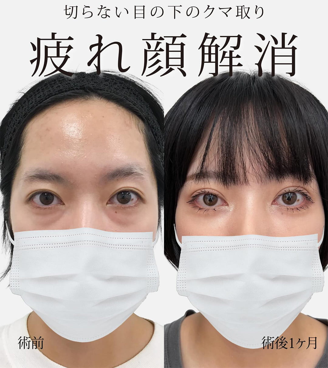 切らない目の下のクマ取り・目の下のたるみ（ふくらみ）取りの症例写真01