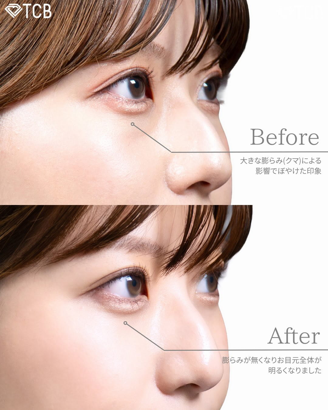 切らない目の下のクマ取り・目の下のたるみ（ふくらみ）取りの症例写真02