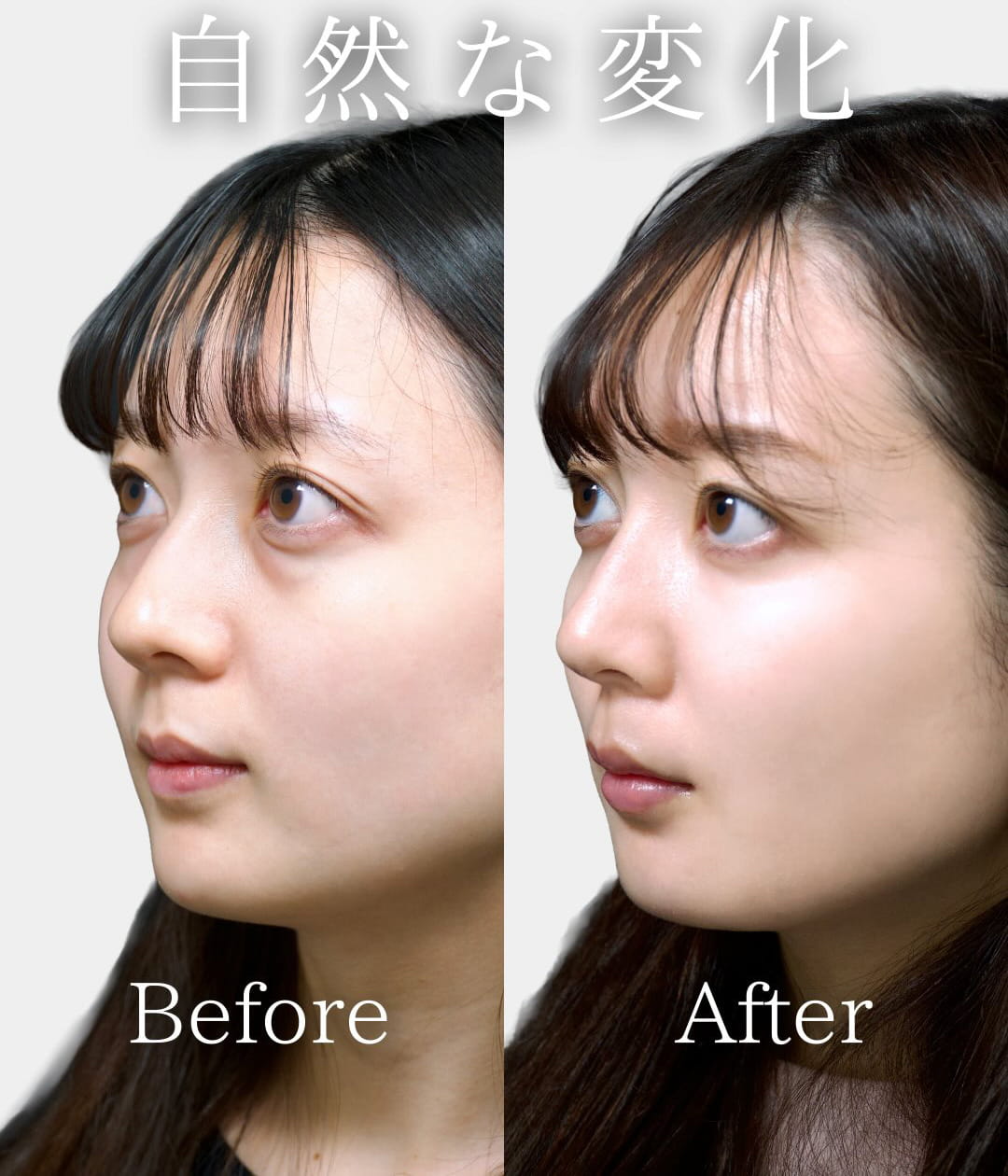 切らない目の下のクマ取り・目の下のたるみ（ふくらみ）取りの症例写真03