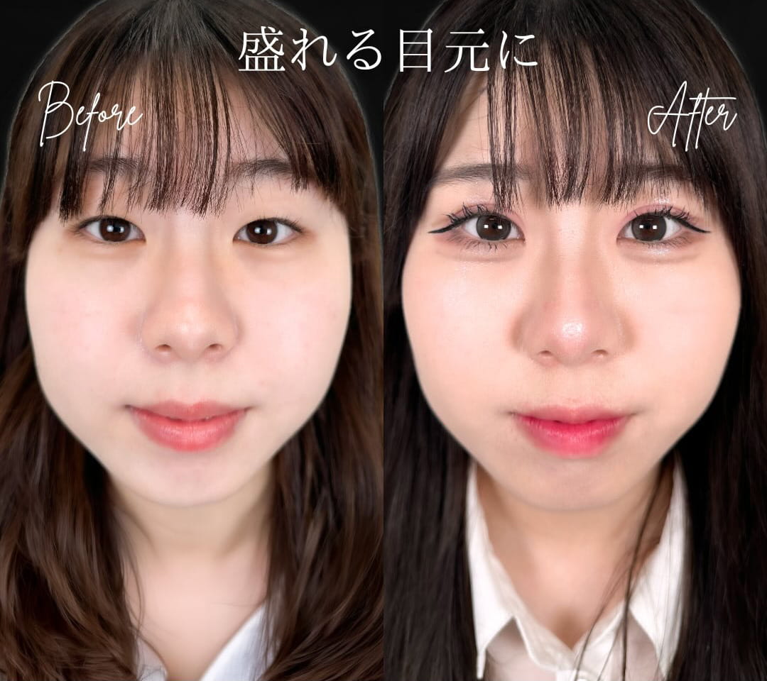 二重埋没の症例写真01