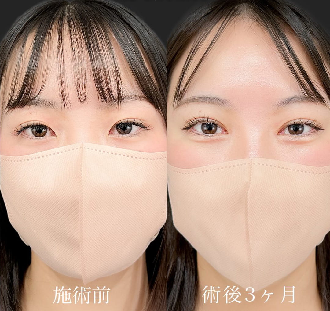 二重埋没の症例写真02