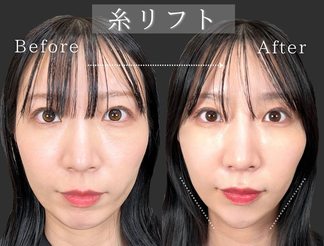 小顔美肌再生の症例写真01