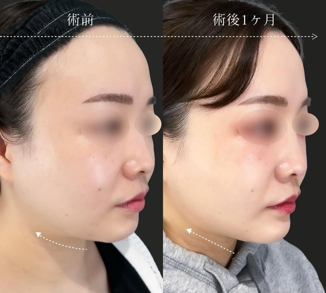 小顔美肌再生の症例写真02