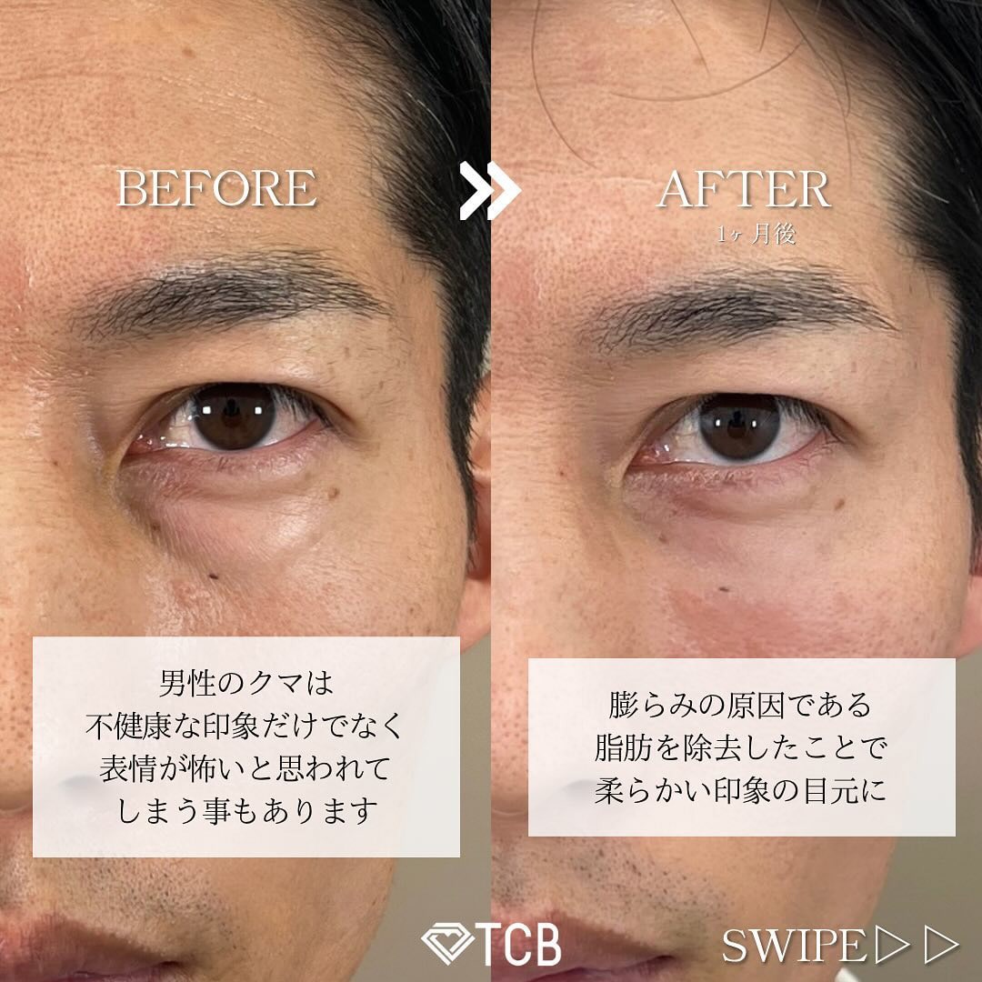 切らない目の下のクマ・たるみ取りの症例写真02