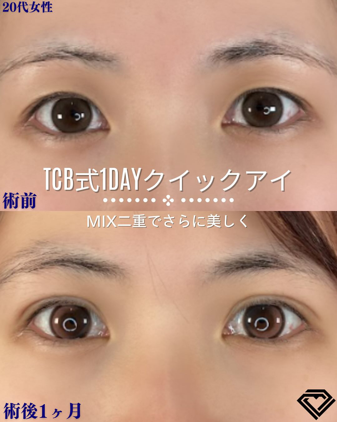 二重埋没の症例写真01