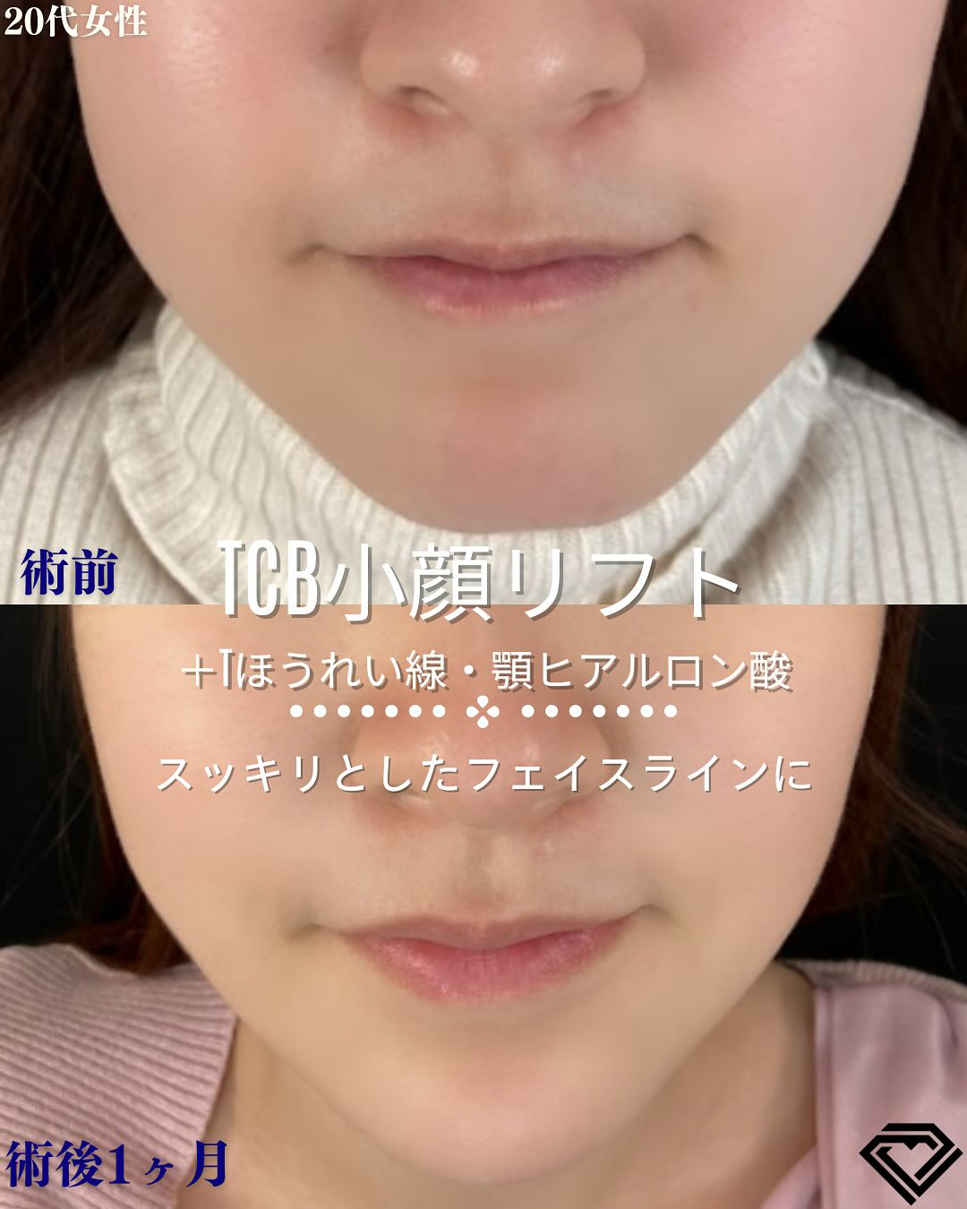 TCB小顔リフトの症例写真01