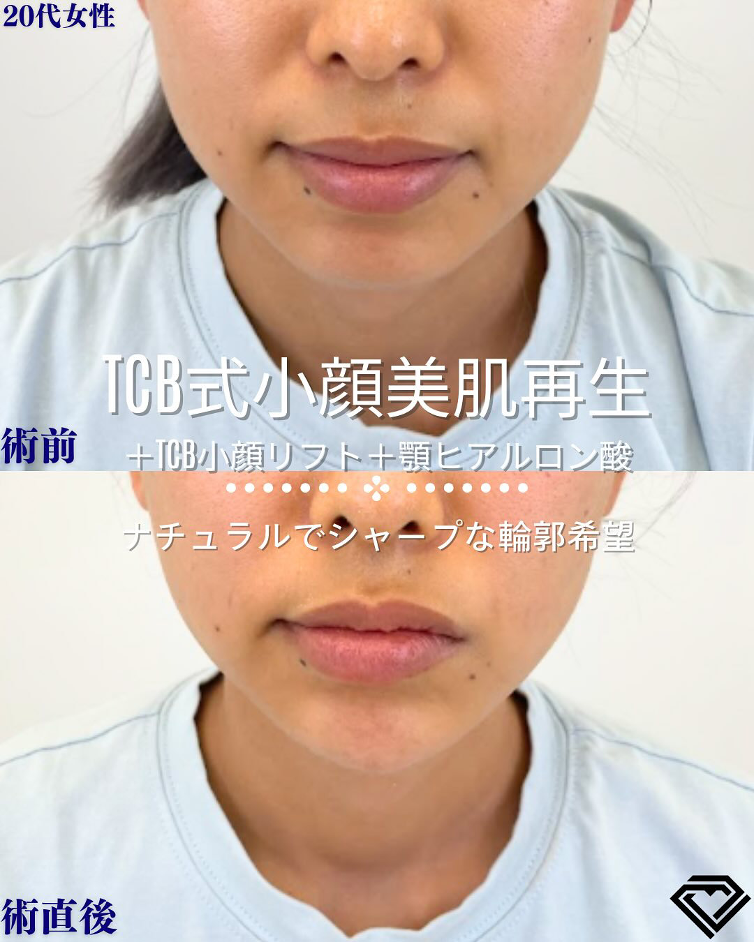 小顔美肌再生の症例写真01